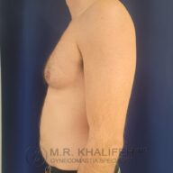 A shirtless adult male stands in profile against a dark blue background, showing mild chest enlargement. Text at bottom reads "M.R. Khalifeh MD, Gynecomastia Specialist.