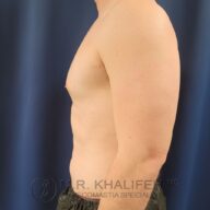 A shirtless man is shown from the side against a dark blue background, wearing black shorts. Text at the bottom reads, "M.R. Khalifeh MD Gynecomastia Specialist.