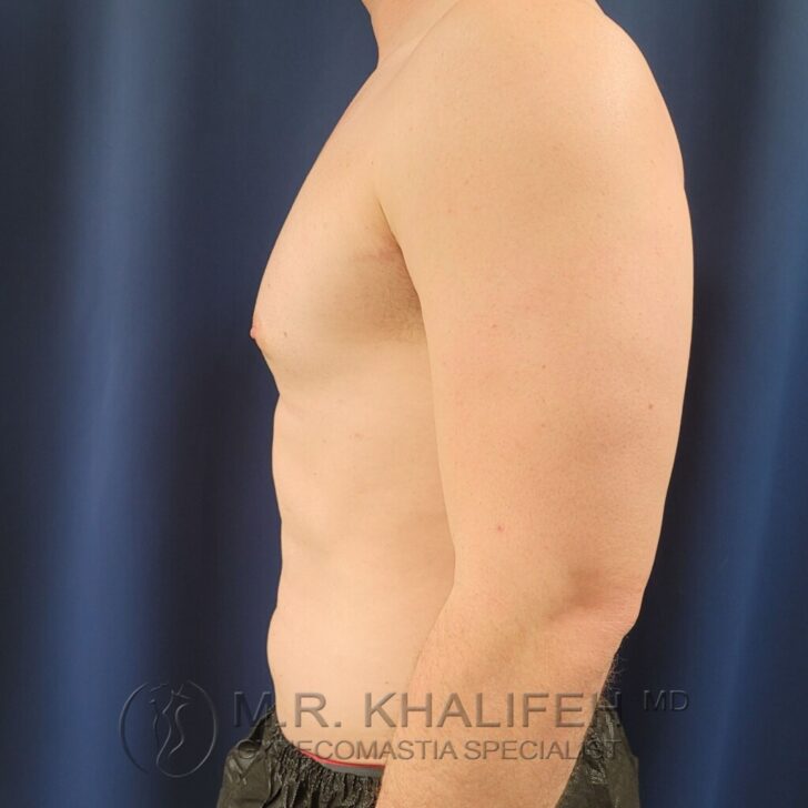 A shirtless man is shown from the side against a dark blue background, wearing black shorts. Text at the bottom reads, "M.R. Khalifeh MD Gynecomastia Specialist.