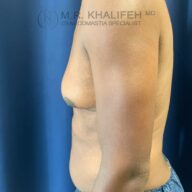 A person with gynecomastia is shown from the side, with visible enlarged breast tissue and a blue curtain background.