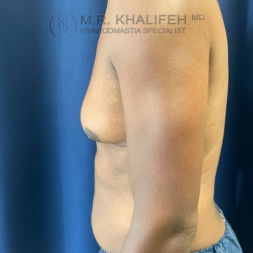 A person with gynecomastia is shown from the side, with visible enlarged breast tissue and a blue curtain background.