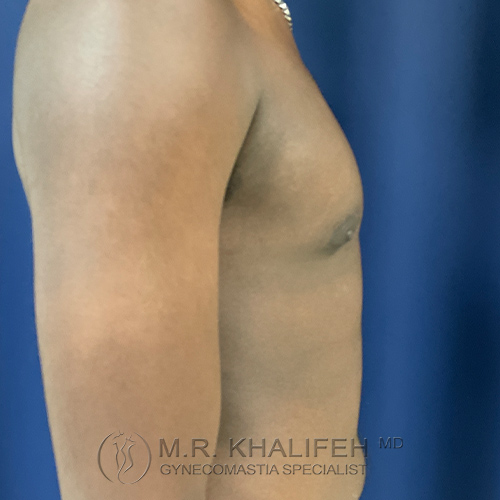 Side view of a shirtless person with a visible, slightly enlarged male breast, standing against a blue background. Text at bottom reads "M.R. Khalifeh MD Gynecomastia Specialist.