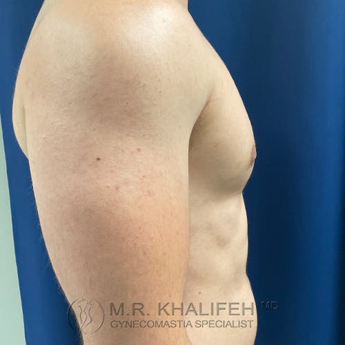 Side view of a shirtless person’s upper body with visible chest contour; blue background and a watermark reading “M.R. Khalifeh MD Gynecomastia Specialist.”.
