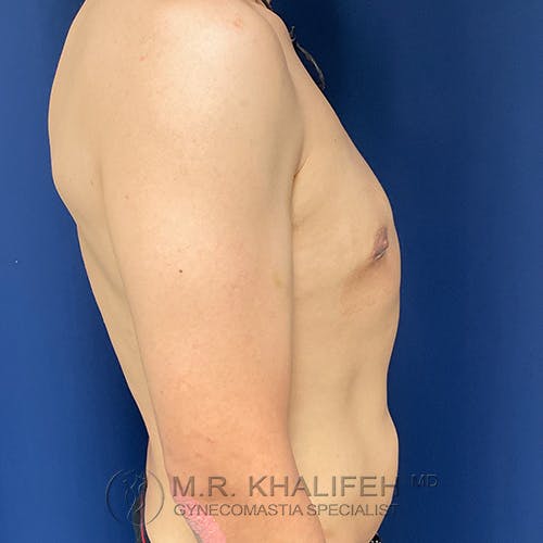 A shirtless person shown from the side against a blue background, with text at the bottom reading "M.R. Khalifeh MD Gynecomastia Specialist.
