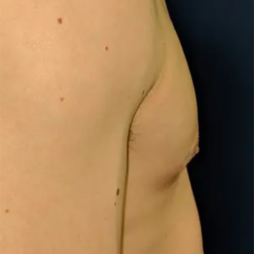 Close-up of a person's chest showing a noticeable indentation or depression near the armpit area against a dark background.