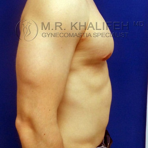 A shirtless person with a bare chest and arm is shown in profile against a blue background. The image includes the text "M.R. Khalifeh MD Gynecomastia Specialist.