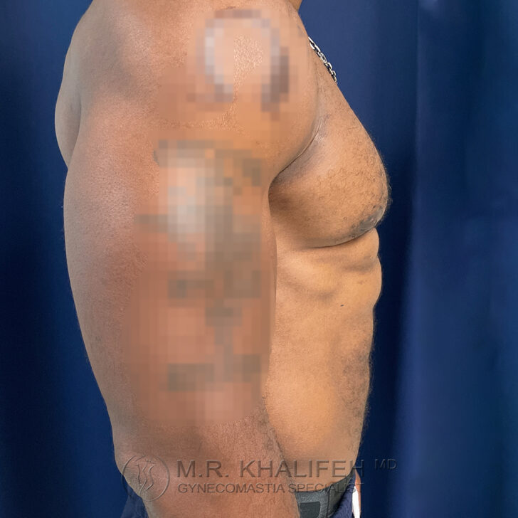 A shirtless person stands in profile against a dark background, showing the side of their torso and arm; tattoos on the arm are blurred.