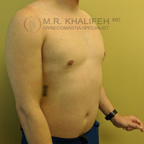 A shirtless adult male with visible gynecomastia stands against a plain yellow wall. The doctor's watermark, "M.R. Khalifeh MD, Gynecomastia Specialist," overlays the image.