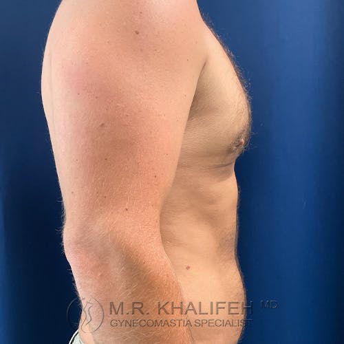 Side profile of an adult male torso against a blue background, with visible chest and arm, and a logo for a gynecomastia specialist at the bottom.