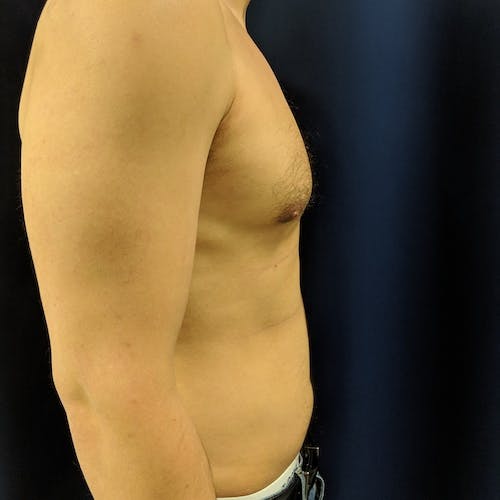 A shirtless person is shown from the side against a dark background, displaying the upper body, arm, and partial abdomen.