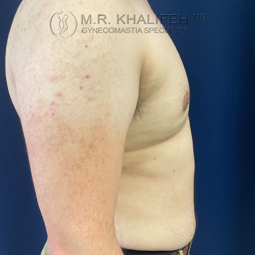 Side view of a shirtless male torso with visible gynecomastia and some red spots on the upper arm, standing against a blue background.