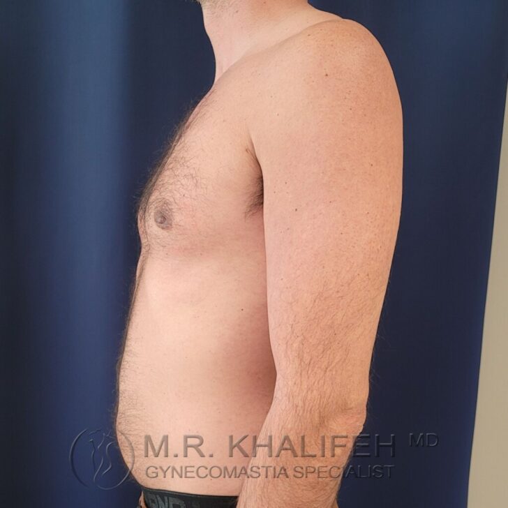 A shirtless adult male is shown in a side profile against a plain dark background, with "M.R. Khalifeh MD Gynecomastia Specialist" watermarked at the bottom.