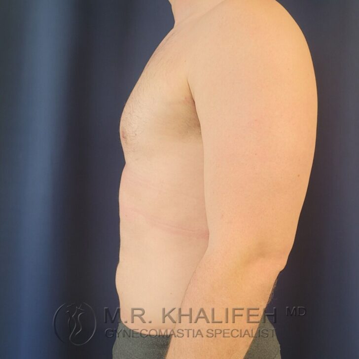 Side view of a shirtless man standing against a dark background, displaying chest and abdomen; text at bottom reads "M.R. Khalifeh MD Gynecomastia Specialist.