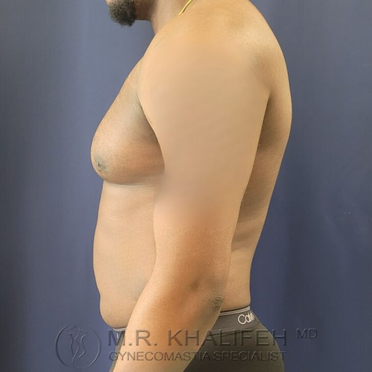 A shirtless person with visible gynecomastia standing in profile against a dark background. Logo and name "M.R. Khalifeh MD Gynecomastia Specialist" visible at the bottom.