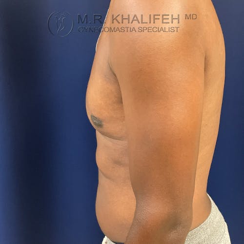 Side view of a shirtless person with visible gynecomastia, standing against a blue background, wearing light-colored pants.