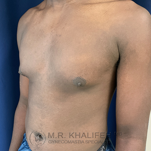 A shirtless person with visible swelling of breast tissue on the left side of the chest, standing against a blue background.