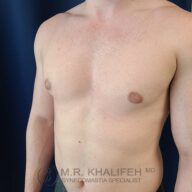 A shirtless adult male with a bare chest stands against a dark background; watermark at bottom reads "M.R. Khalifeh MD Gynecomastia Specialist.