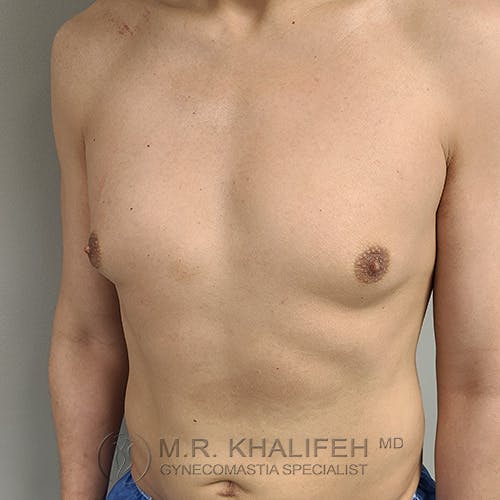 A person with a bare chest showing mild gynecomastia, standing against a plain background.