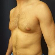 A shirtless adult male torso is shown from the left side, highlighting uneven chest contour against a dark background.