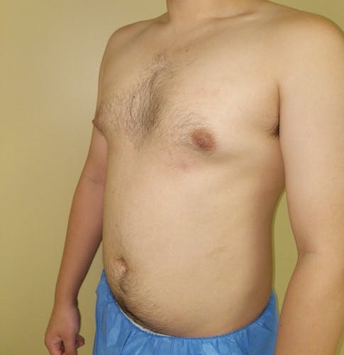 A shirtless person standing against a beige wall, wearing blue medical shorts, displaying their chest and abdomen.