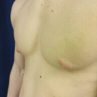 A close-up of a person's bare chest showing an indentation on the left side of the chest wall, suggestive of pectus excavatum.