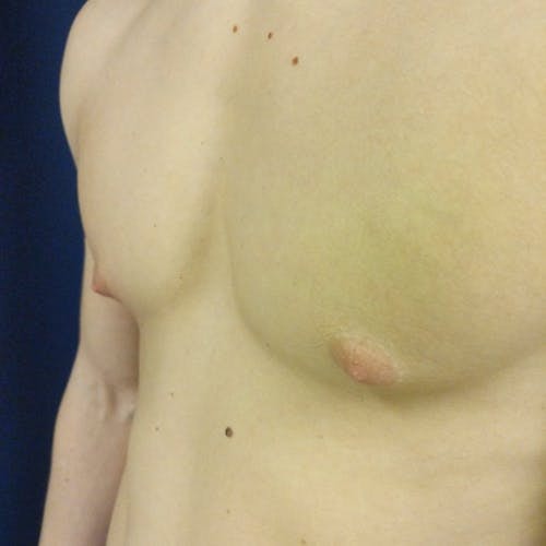 A close-up of a person's bare chest showing an indentation on the left side of the chest wall, suggestive of pectus excavatum.