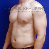 A shirtless man with a bare chest stands against a blue background, showing results of gynecomastia treatment. Text reads "M.R. Khalifeh MD Gynecomastia Specialist.