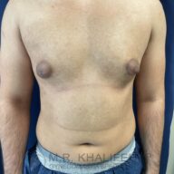 A shirtless person with visible gynecomastia stands against a dark background, arms relaxed at their sides.
