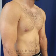 A shirtless man shown from the neck to the waist in a side angle against a blue background; watermark text reads "M.R. Khalifeh MD Gynecomastia Specialist.