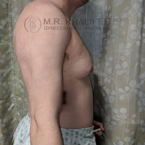 Side view of a shirtless adult male with visible breast tissue, standing against a patterned curtain, wearing medical shorts.
