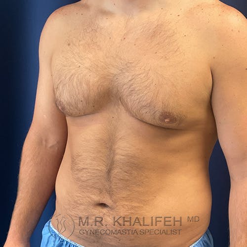 A shirtless adult male with visible gynecomastia stands against a blue background, with the logo "M.R. Khalifeh MD Gynecomastia Specialist" at the bottom.