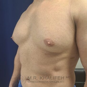 A shirtless person with visible gynecomastia standing in a clinical setting, showing the chest and upper abdomen from a side angle.