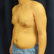 A shirtless adult male with visible chest and abdominal fat stands in front of a dark curtain, wearing blue medical shorts.