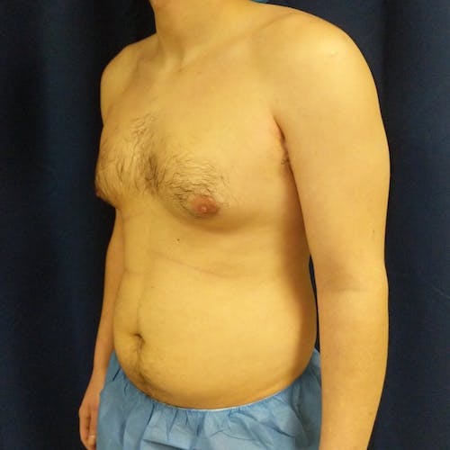 A shirtless adult male with visible chest and abdominal fat stands in front of a dark curtain, wearing blue medical shorts.