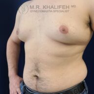 A shirtless person with visible gynecomastia stands against a dark blue background, with a medical specialist’s watermark in the top left corner.