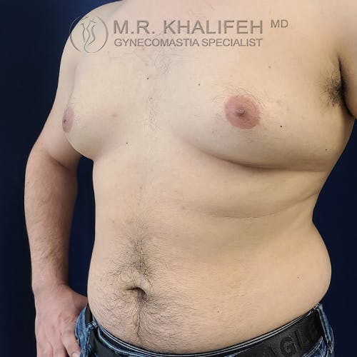 A shirtless person with visible gynecomastia stands against a dark blue background, with a medical specialist’s watermark in the top left corner.