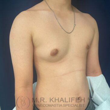 A person with visible gynecomastia on the left side of the chest, standing partially draped, wearing a chain necklace. Logo and text indicate a gynecomastia specialist.