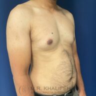 A shirtless adult male stands against a blue background, showing enlarged breast tissue commonly associated with gynecomastia.