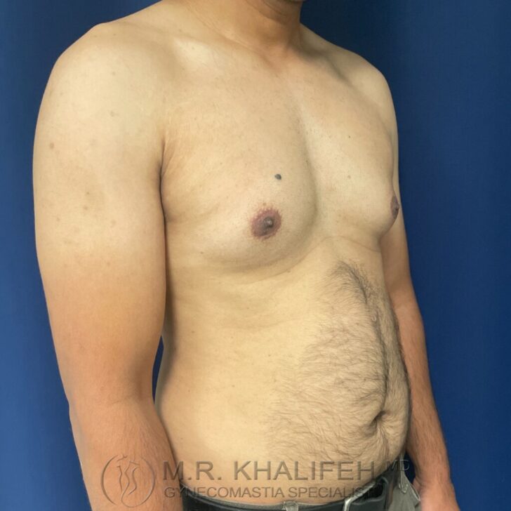 A shirtless adult male stands against a blue background, showing enlarged breast tissue commonly associated with gynecomastia.