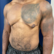 Adult male torso with visible gynecomastia, showing enlarged breast tissue. Tattoos on chest and arm are blurred. Person is standing against a blue background.