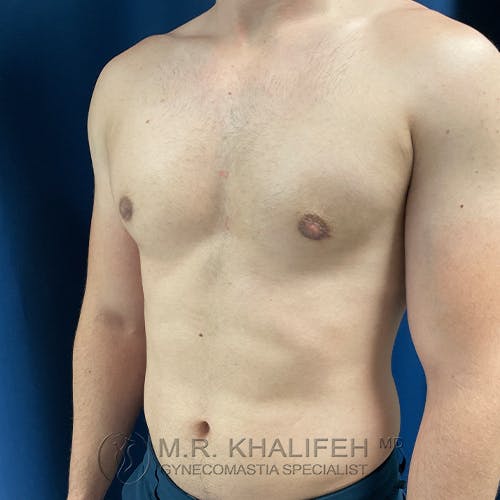 A shirtless person with a bare chest is standing against a blue background, showing the upper torso and arms. Text at the bottom reads "M.R. Khalifeh, MD, Gynecomastia Specialist.