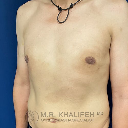 A shirtless person with a flat chest is standing against a blue background, wearing a black necklace. Text at the bottom reads "M.R. Khalifeh MD Gynecomastia Specialist.