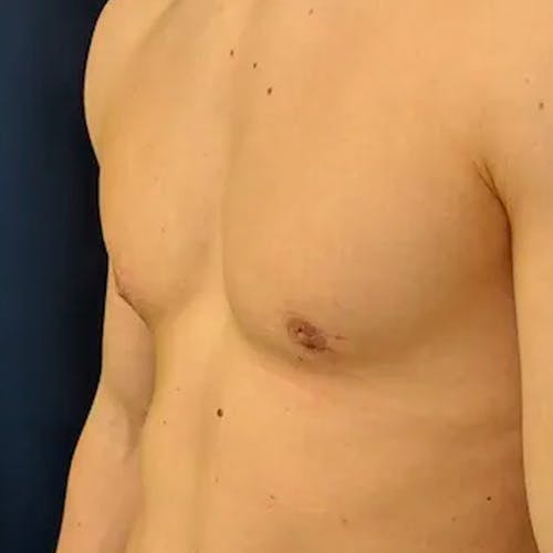 A close-up view of a shirtless person’s upper torso and chest, shown from the side against a plain dark background.