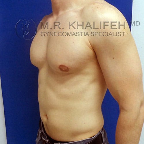 A shirtless person stands against a blue background, showing their upper body and chest in profile view. Text overlay reads "M.R. Khalifeh, MD, Gynecomastia Specialist.
