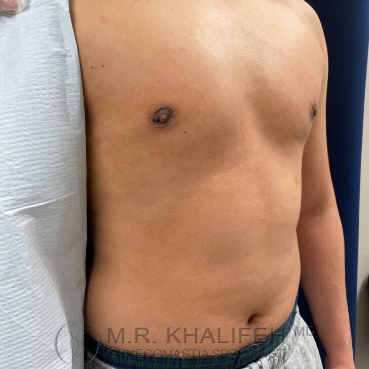 A person’s bare chest and abdomen are shown from the front and side, with one nipple visible; the individual is partially draped with a medical sheet.