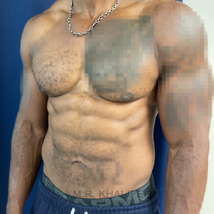 A shirtless man wearing a chain necklace and dark shorts stands against a blue background; his chest, left arm, and groin areas are pixelated for privacy.