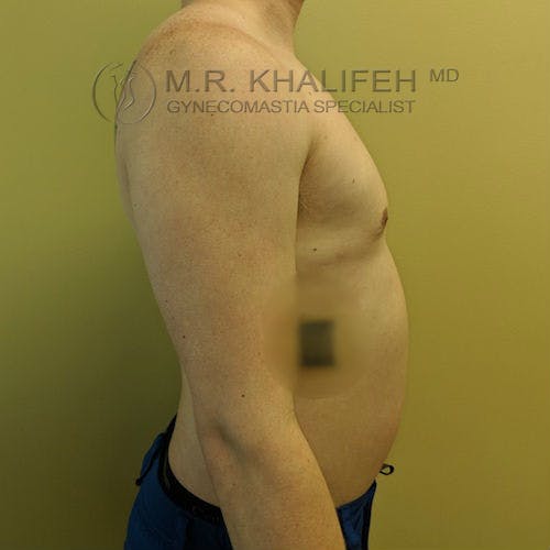 Side view of a shirtless adult male with a slightly protruding abdomen, standing against a plain background. Text on the image reads "M.R. Khalifeh MD Gynecomastia Specialist.
