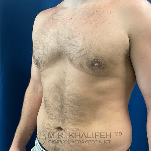 A shirtless person with a flat chest and visible chest hair stands against a blue background. Text at the bottom reads "M.R. Khalifeh MD Gynecomastia Specialist.