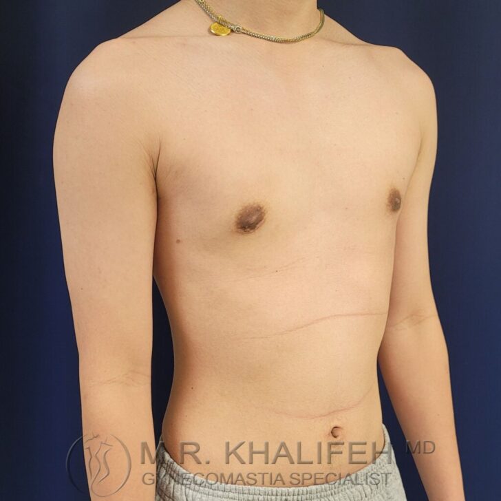 A shirtless person with a flat chest stands against a dark background, wearing a necklace and gray pants. The watermark "M.R. Khalifeh MD Gynecomastia Specialist" is visible at the bottom.