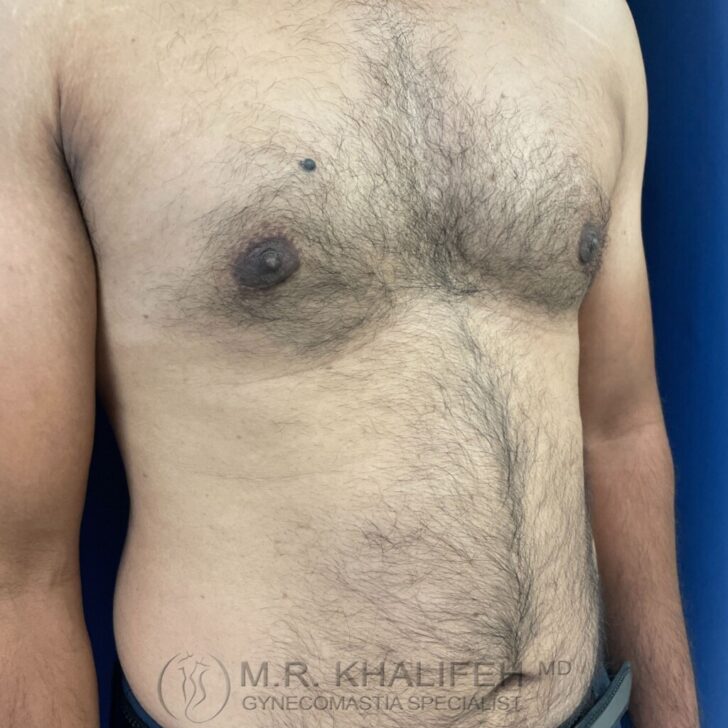 A shirtless male torso with visible gynecomastia, standing against a blue background. The image features the logo and name of a gynecomastia specialist at the bottom.